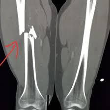 CECT-Right-Thigh