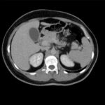 CECT Triple Phase Upper Abdomen