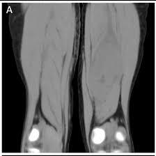 CT Bilateral Thigh And Leg