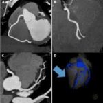 CT Cardiac Angiography