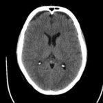 CT Head Contrast