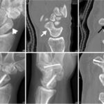 CT Left Scaphoid