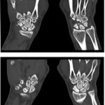 CT Right Scaphoid Scan