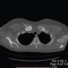 CT Scan Left Clavicle