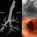 CT Virtual Bronchoscopy