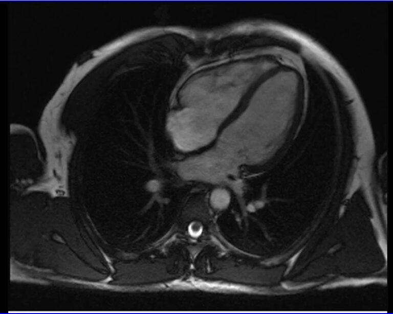Cardiac MRI With CINE