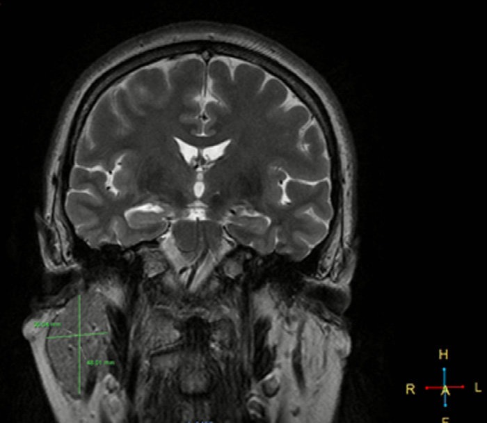 MRI Parotid Gland