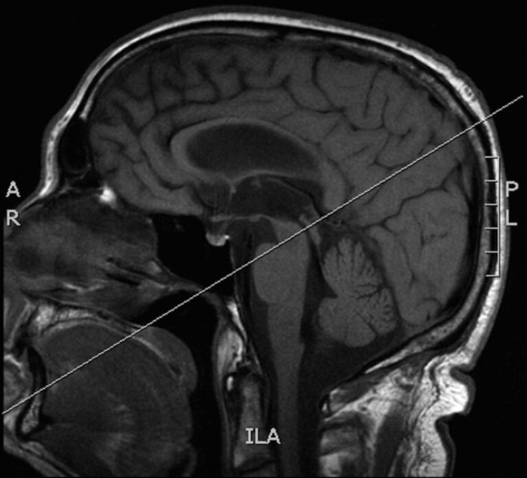 MRI Brain With CSF Flow Study