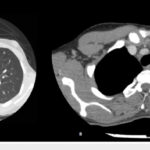 HRCT Chest With Contrast