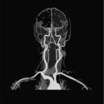 MR Angiography Neck Vessels