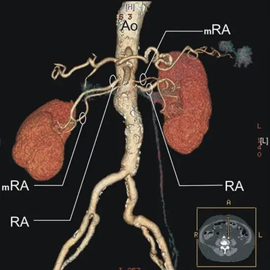 MR-Angiography-Right-Kidney