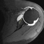 MR Arthrogram Scan