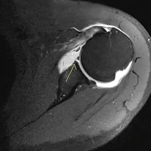 MRI Scan For MR Arthrogram | Medifyhome