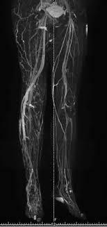 MR Venography Right Lower Limb