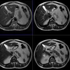 MRCP-With-Whole-Abdomen