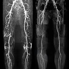 MRI Angiography Left Lower Limb