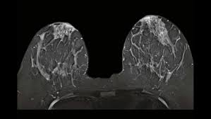 MRI Breast