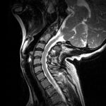MRI Cervical Spine