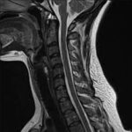 MRI Cervical Spine With Contrast