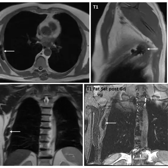 MRI Chest