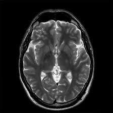 MRI-Cranium