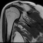 MRI Extremities