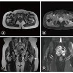 MRI Gluteal Region