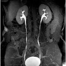 MRI-Kub-With-Urography