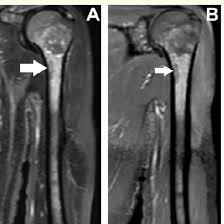 MRI Left Arm With Contrast