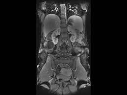 MRI-Lower-Abdomen-Screening