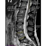 MRI Lumbar Spine