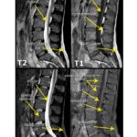 MRI Lumbar Spine with Contrast