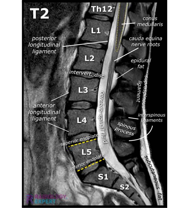 MRI Lumbar Spine