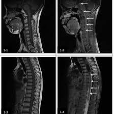 MRI Medulla Plain