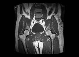 MRI Pelvis