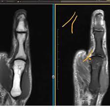 MRI-Right-Thumb