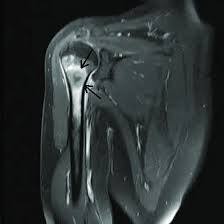 MRI-Right-Upper-Limb