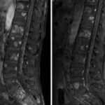 MRI Sacral Spine With Contrast