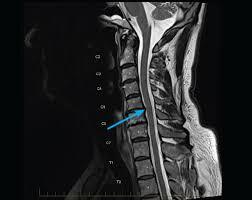 MRI Scan Neck