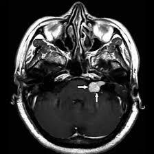 MRI Scan Temporal Bone