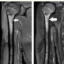 MRI Screening Of Arm