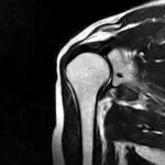 MRI Screening Of Right Shoulder