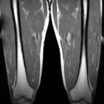 MRI Screening Of Thigh