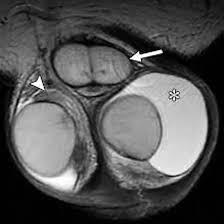 MRI Scrotum