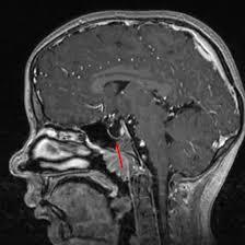 MRI Sella