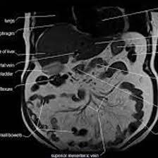 MRI Umbilical Region