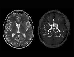 MRI and MRA Of Brain