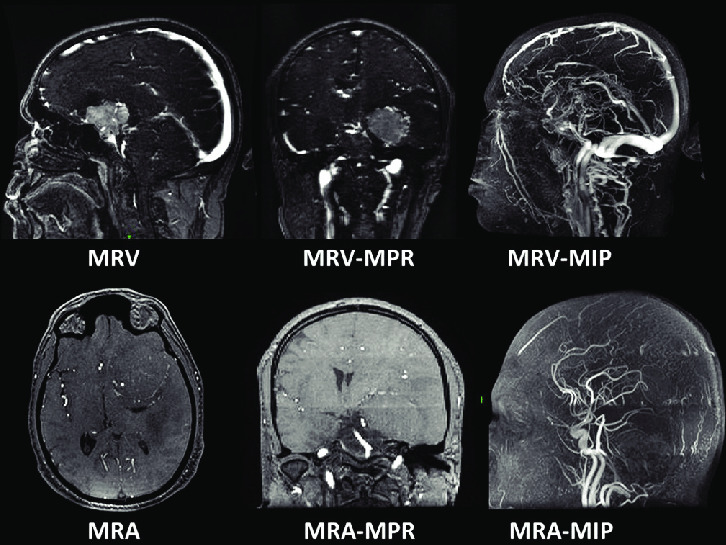 MRI and MRV Brain