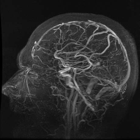 MRI & MR Angiography Brain Scan