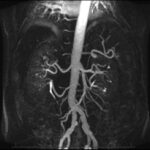 MRI Angiography Abdominal Aorta